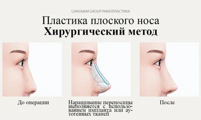 Все О Пластике С Компанией Benefit - ⚜️ПОВТОРНАЯ РИНОПЛАСТИКА👃🏻 В ЮЖНОЙ  КОРЕЕ🇰🇷⚜️ 🔹Повторная ринопластика (пластика носа👃🏻) – это вид  пластической операции, направленный на исправление носа. Такое  вмешательство необходимо в тех случаях, когда