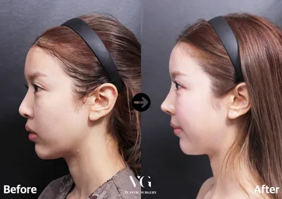 Ринопластика в Южной Корее | Gangnam Group Plastic Surgery