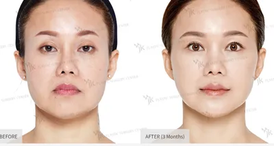 Ринопластика в Южной Корее | Gangnam Group Plastic Surgery