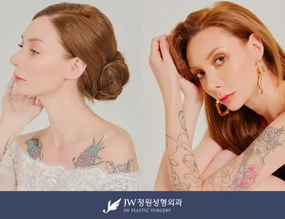 Before After Nose Surgery At JW Clinic In Seoul, South Korea