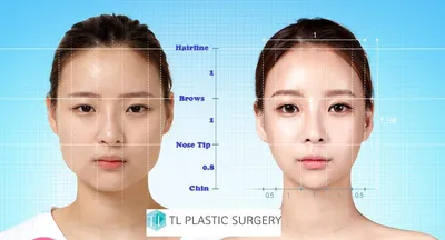 POP Plastic Surgery Russia - ПЛАСТИКА НОСА В КОРЕЕ 📲 Imo / Kakao Talk:  010-5037-0025 WhatsApp: https://bit.ly/3gjcGy8 ⠀⠀ Ринопластика - это  пластическая операция, направленная на исправление эстетических недостатков  носа. Метод операции выбирает