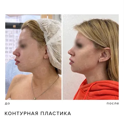 Моделирование овала лица филлерами в Москве по цене от 21855 руб. в клинике  Beauty Trend