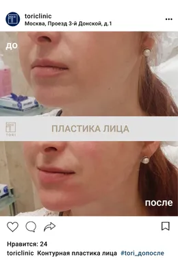 Контурная пластика: процедура, виды, преимущества | Telos Beauty