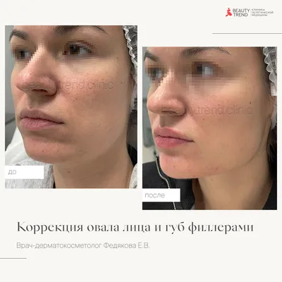 Jūsu Kosmetologs - 💉🔥Kонтурная пластика “Full Face” одновременно решает  множество задач: устраняет возрастные изменения, корректирует морщины,  носогубные складки, носослезные борозды, восстанавливает утраченный объем,  подтягивает овал лица, увлажняет ...