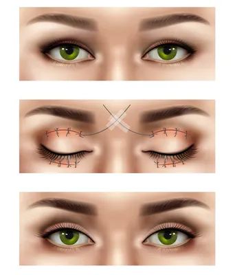 Блефаропластика в Киеве: стоимость круговой блефаропластики (пластика век),  цена на круговую блефаропластику