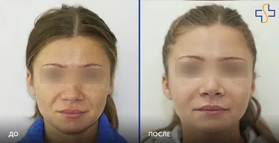 Эндоскопический лифтинг средней зоны лица: фото работ До и После