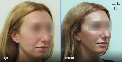Контурная пластика средней трети лица (носослезная, носощечная и носогубная зона  лица)