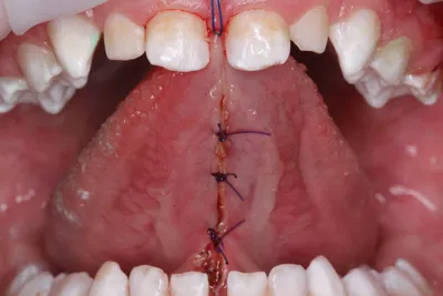 Пластика уздечки языка - Сеть стоматологических клиник Санкт-Петербурга -  Мир стоматологии