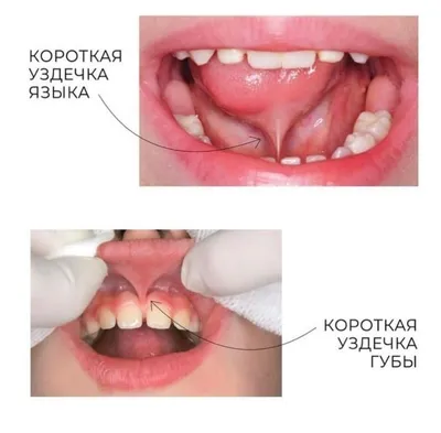 Пластика уздечек языка, верхней и нижней губы у детей | Стоматологическая  клиника «Мартинка»