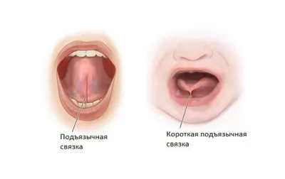 Пластика уздечки языка: цены на лазерную коррекцию в Москве - Стоматология  Елены Мокренко