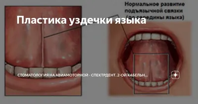 Пластика уздечки языка с использованием лазера | Детская и семейная  стоматологическая клиника \"Белая Медведица\" | Санкт-Петербург