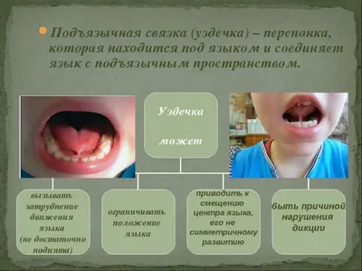 Пластика уздечки языка, стоимость пластики уздечки языка в  стоматологической клинике в Люблино