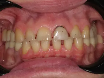 Пластика уздечки верхней губы диодным лазером Doctor Smile :: NORD DENTAL —  семейная стоматология. Две клиники на севере Петербурга