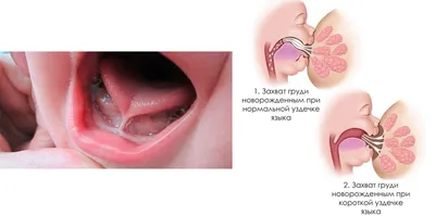 Пластика уздечки языка и губ. Цены пластики уздечки языка и губ в 2022 году  | Стоматология АлексДент