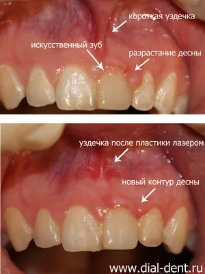 Пластика уздечек губ и языка в Москве