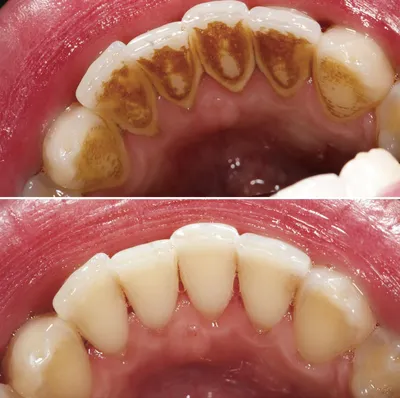 Пластика уздечки верхней губы диодным лазером Doctor Smile :: NORD DENTAL —  семейная стоматология. Две клиники на севере Петербурга