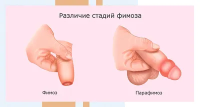 Обрезание у мальчиков ✓ Как проходит процедура ✓ Важные вопросы | Medcity.ua