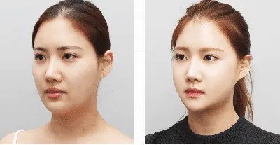 Пластическая хирургия в Корее / До и после / Plastic Surgery in Korea /  Before and After HD - YouTube