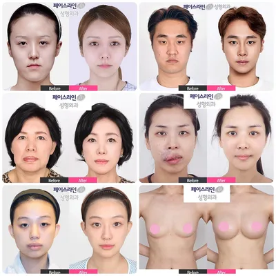 Beauty-Portal Korea - #Repost @wonjincis with @use.repost ・・・ Почему  операция V line так популярна в Корее? 🌷 . Благодаря челюстно-лицевой  контурной пластике V line можно получить желаемый четкий V-образный контур  лица и