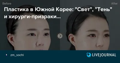 Пластические операции в Корее, которые вас удивят | Записки из Кореи🇰🇷 |  Дзен