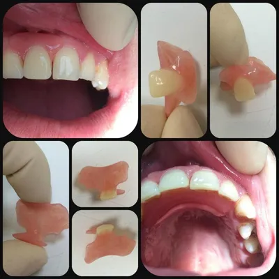 Зубной иммедиат протез-бабочка: цены в стоматологии Москвы | НоваДент