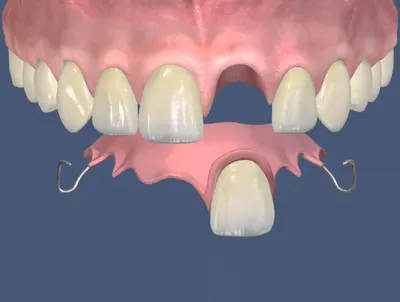 Зубной иммедиат протез-бабочка: цены в стоматологии Москвы | НоваДент