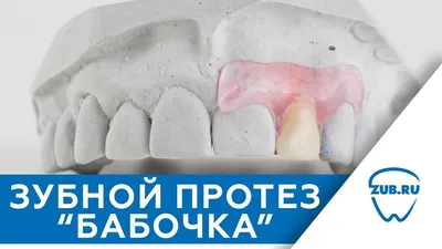 Зубной протез «Бабочка» в Москве – цены, отзывы на установку в  стоматологических клиниках Зуб.ру