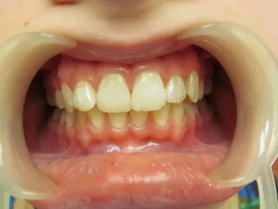 Как выглядит пластина для исправления и выравнивания зубов детям – как ее  ставят ребенку, в каком возрасте носят, что она делает, для чего нужна и  как называется слепок