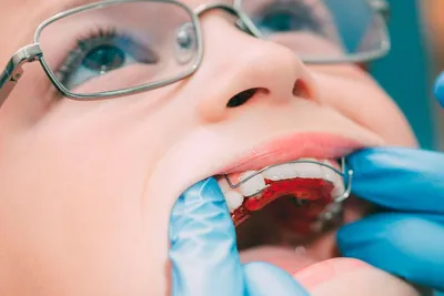Как выглядит пластина для исправления и выравнивания зубов детям – как ее  ставят ребенку, в каком возрасте носят, что она делает, для чего нужна и  как называется слепок