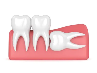 Выравнивание зубов брекетами и пластинками, прозрачными каппами | Семейная  стоматология НОВИВ