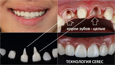 Почему натирает зубной протез и что делать