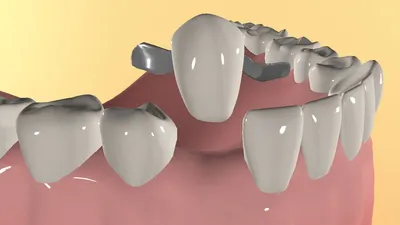 Съемные и частично-съемные протезы в Тюмени – цены в Мега-Дент