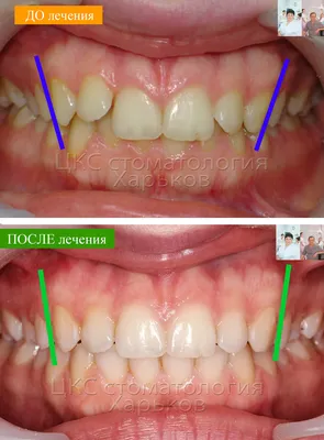 Имплантация зубов. Как устанавливают импланты - drkondratev.ru