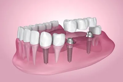 Какие импланты лучше - как выбрать импланты зубов