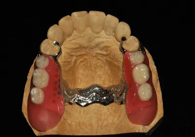 Фиксация зубных протезов — методы и средства крепления съемных и несъемных  конструкций
