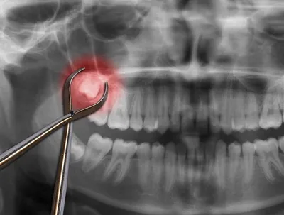 Капы или брекеты: что выбрать для выравнивания зубов в ортодонтической  стоматологии