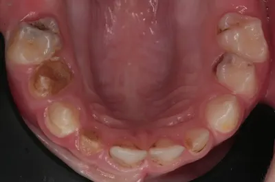 Стоматологическая модель 32, съемные ввинчиваемые зубные мягкие десны для  kilгор Nissin | AliExpress