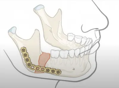 Установка пластин при переломах челюсти: способы и особенности остеосинтеза