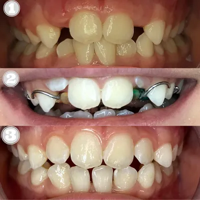Пластинки для выравнивания зубов у детей в Москве по доступным ценам в  детской стоматологии Зубрёнок
