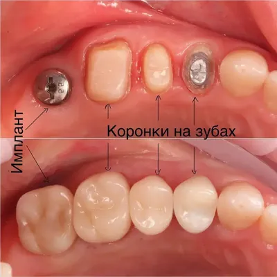 Коронки для нижних зубов в Москве - цены в стоматологии