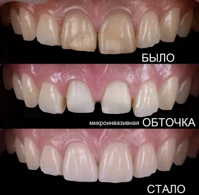 1️⃣ Коронки зубов Алматы | Клиника «Dental Center»