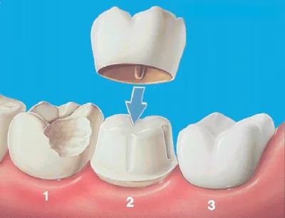 Установка коронок на зубы: виды коронок, где поставить коронк