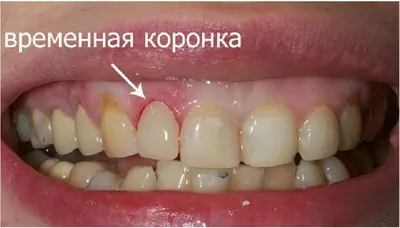 Циркониевые коронки в Минске, коронка из циркония