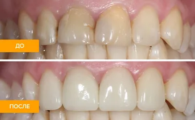 Пластмассовые зубы: коронки и съемные зубные протезы