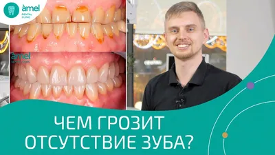 Коронки на передние зубы | TopDent | Дзен