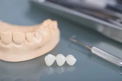 Установка пластмассовых коронок на зубы в Перми - цена | АЛТЕЙДЕНТ