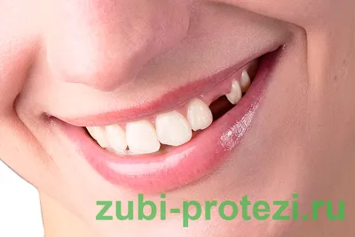 Коронки на зубы по СУПЕР цене 12 400 ₽ под ключ - ProЗубы