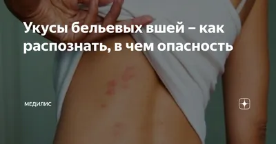 Кто-то кусает в постели ночью, но не видно. Кто это может быть? - СЭС