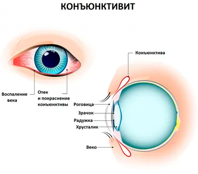 Конъюнктивит: виды, симптомы, лечение | Optika24.by | Optika24.by