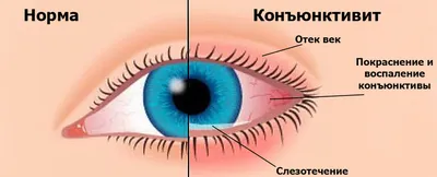 Конъюнктивит – офтальмологическое заболевание, при котором воспалительный  процесс распространяется на слизистую оболочку глаза. 🔹Характерные  симптомы... | By Платная скорая помощь \"Медэкспресс\" г. Алматы | Facebook